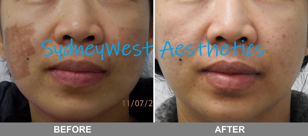 Pigmentation Image -5c6eabecc447b